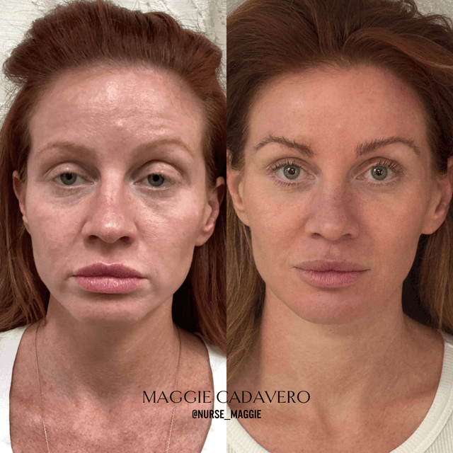 Full face filler and Botox rejuvenation results before and after