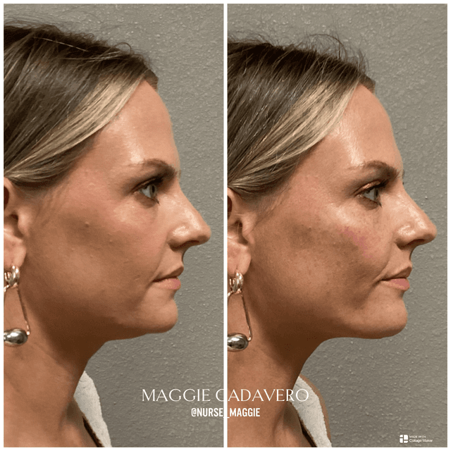 Jawline and chin filler before and after