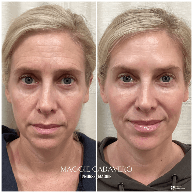 Botox before and after smiling